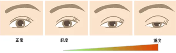 下垂 は 眼瞼 と 眼瞼下垂を予防するトレーニング